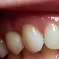 implantacja-zeba-14-z-augementacja-wyrostka-zebodolowego-szczeki-w-przypadku-zaniku-kosci_98_2212.jpg
