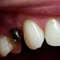 implantacja-zeba-14-z-augementacja-wyrostka-zebodolowego-szczeki-w-przypadku-zaniku-kosci_9_570.jpg