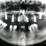 leczenie-implantologiczne_78_699.jpg
